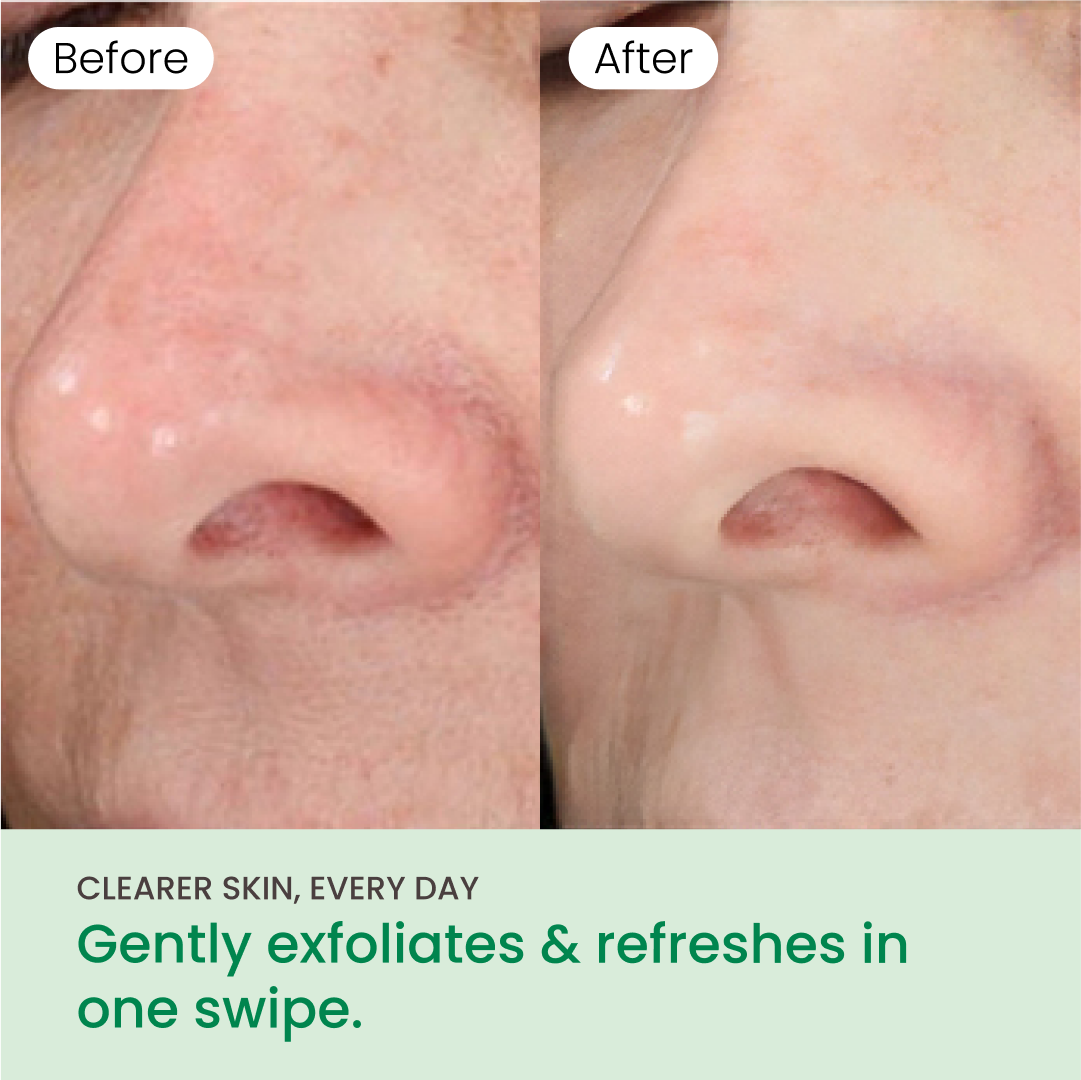 QUIA Toner Pads – AHA/BHA Dual-Action Exfoliate and Hydrate All in One – Soothing Formula for Sensitive Skin – Reduces Blackheads and Blemishes- 70 Gentle Textured Pads – Korean Skincare