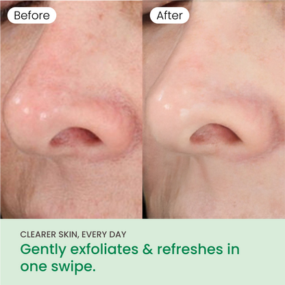 QUIA Toner Pads – AHA/BHA Dual-Action Exfoliate and Hydrate All in One – Soothing Formula for Sensitive Skin – Reduces Blackheads and Blemishes- 70 Gentle Textured Pads – Korean Skincare